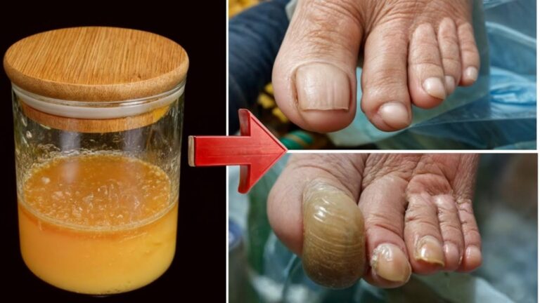Diese einfache Methode lässt Nagelpilz verschwinden und sorgt für gesunde, schöne Nägel…