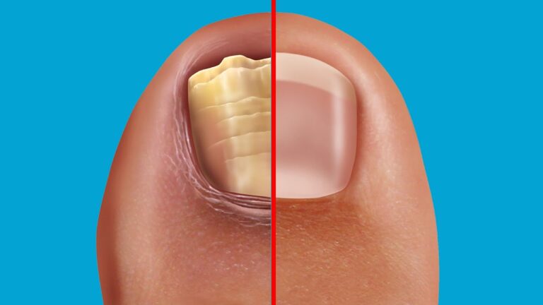5 effektive Hausmittel gegen Nagelpilz für sofortige Linderung entdecken!