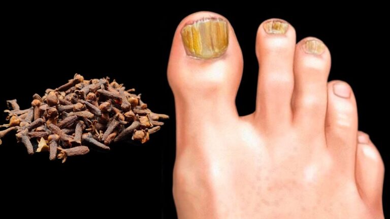 4 effektive Methoden gegen Nagelpilz, die sofort wirken wie ein Radiergummi!