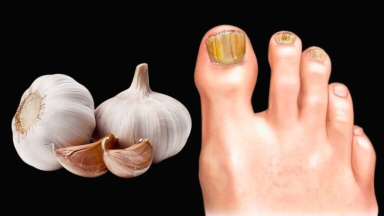 Beseitige Nagelpilz in 5 Tagen mit diesem natürlichen Knoblauchmittel!